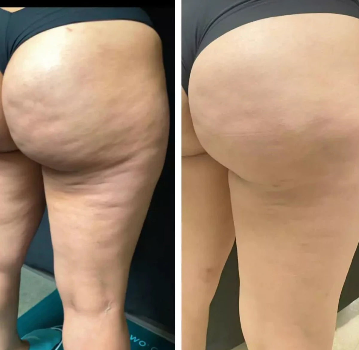 SkinVibe BodyLifter™